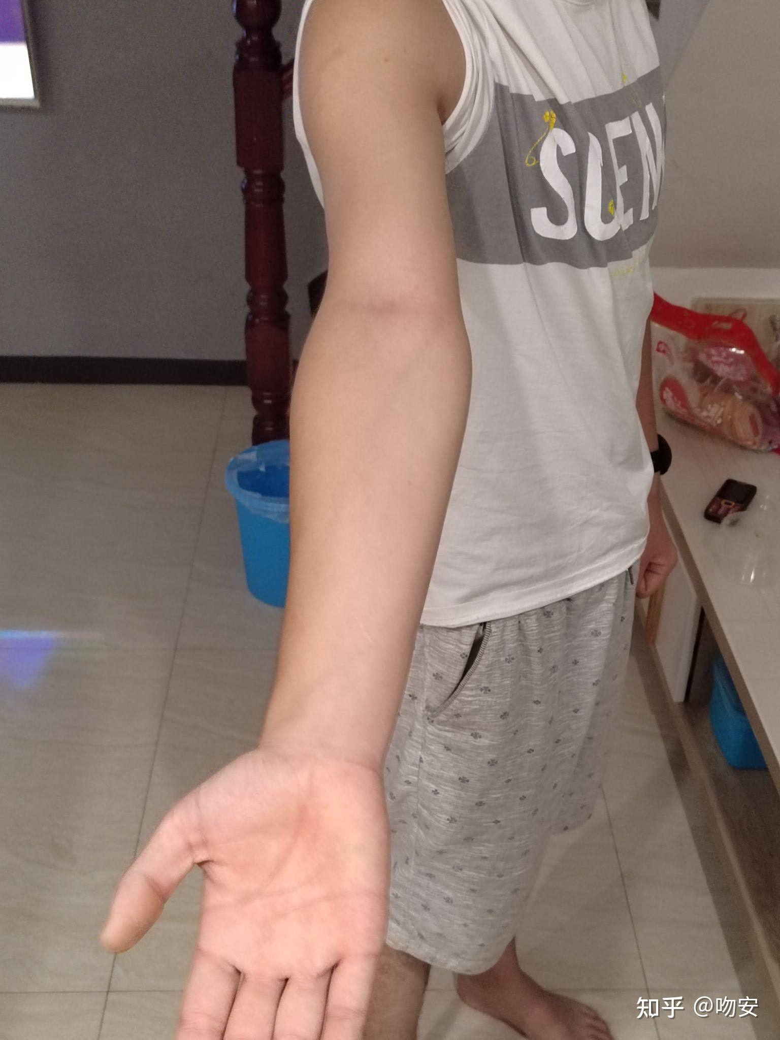 肘外翻20度，兵检过了，挑战与机遇并存，肘外翻20度，兵检通过的挑战与机遇并存之路