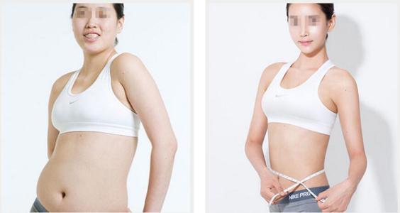 全身抽脂肪30斤的价格及其相关因素探讨,全身抽脂30斤价格及相关因素深度解析