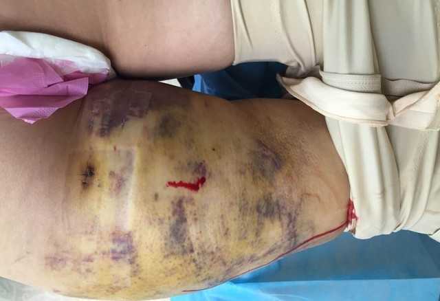 抽脂手术后的痛苦经历，抽脂手术后的艰辛历程